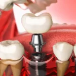 implant tedavisi nedir