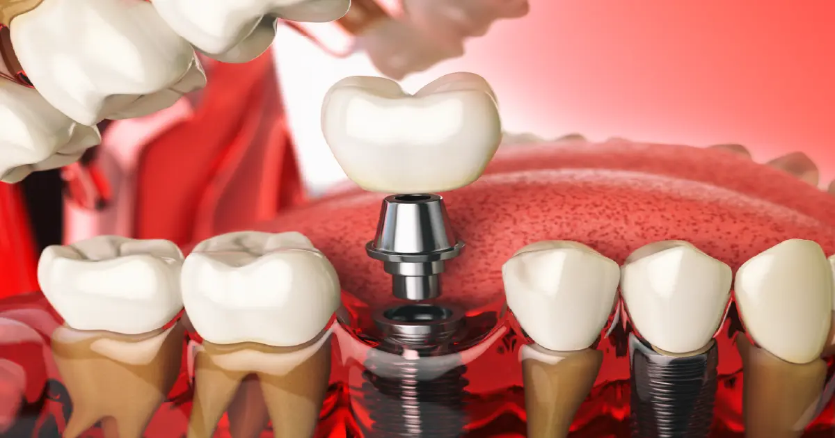 implant tedavisi nedir