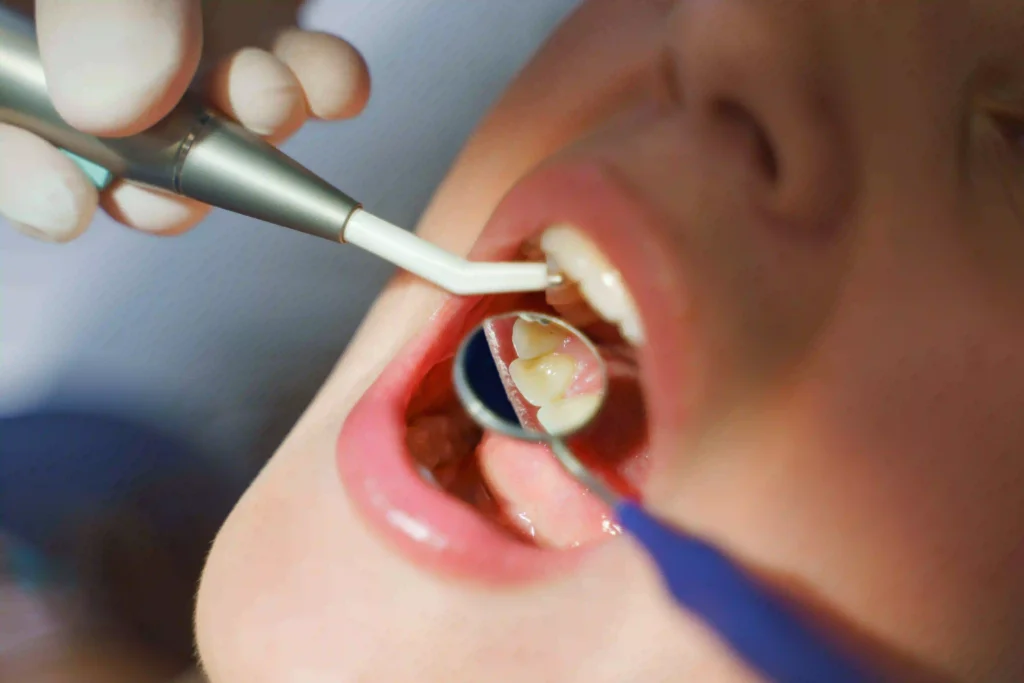 Silivri Özel Sinan Çavuş Diş Kliniği'nde diş çürüklerinin temizlenerek doku kaybının kompozit materyal ile telafi edildiği diş dolgusu işlemi.
