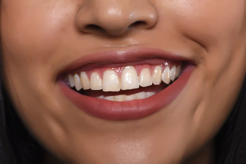 Lamina veneer — Silivri Özel Sinan Çavuş Diş Kliniği'nde diş dokusunun korunarak uygulanan porselen yaprak porselen restorasyonları ve estetik planlama süreci.