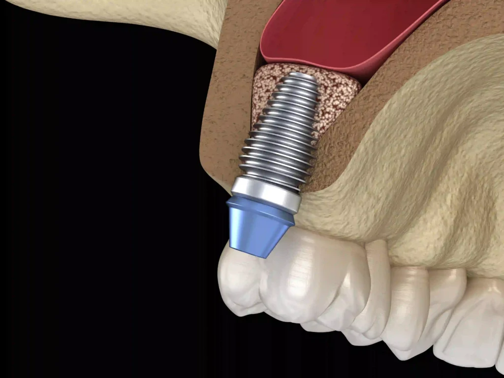 Silivri Özel Sinan Çavuş Diş Kliniği'nde üst çene implant tedavisi öncesinde kemik hacmini artırmak amacıyla uygulanan sinüs lifting (sinüs yükseltme) işlemi. Silivri Sinüs Lifting