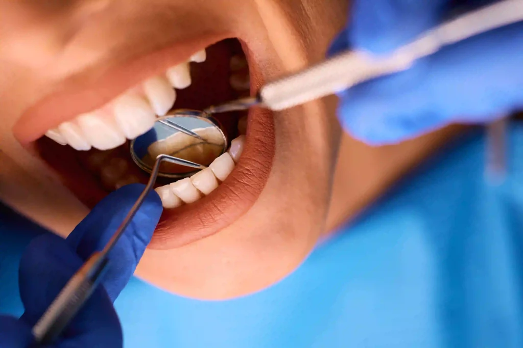 Silivri Diş Taşı Temizliği. Silivri'de periodontal diş eti sağlığını korumak ve diş eti hastalıklarını önlemek amacıyla Uzman Diş Hekimi Sinan Çavuş tarafından titizlikle uygulanan diş taşı temizliği (detartraj) işlemi.
